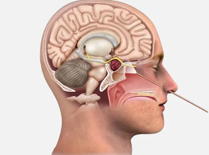 Skull Base & Cranial Base Surgery - IBS Hospital Delhi